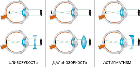 Как очки и линзы корректируют зрение при различных заболеваниях